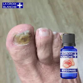 Solución MycoNail - Sinergia antihongos en las uñas