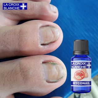 Solución MycoNail - Sinergia antihongos en las uñas